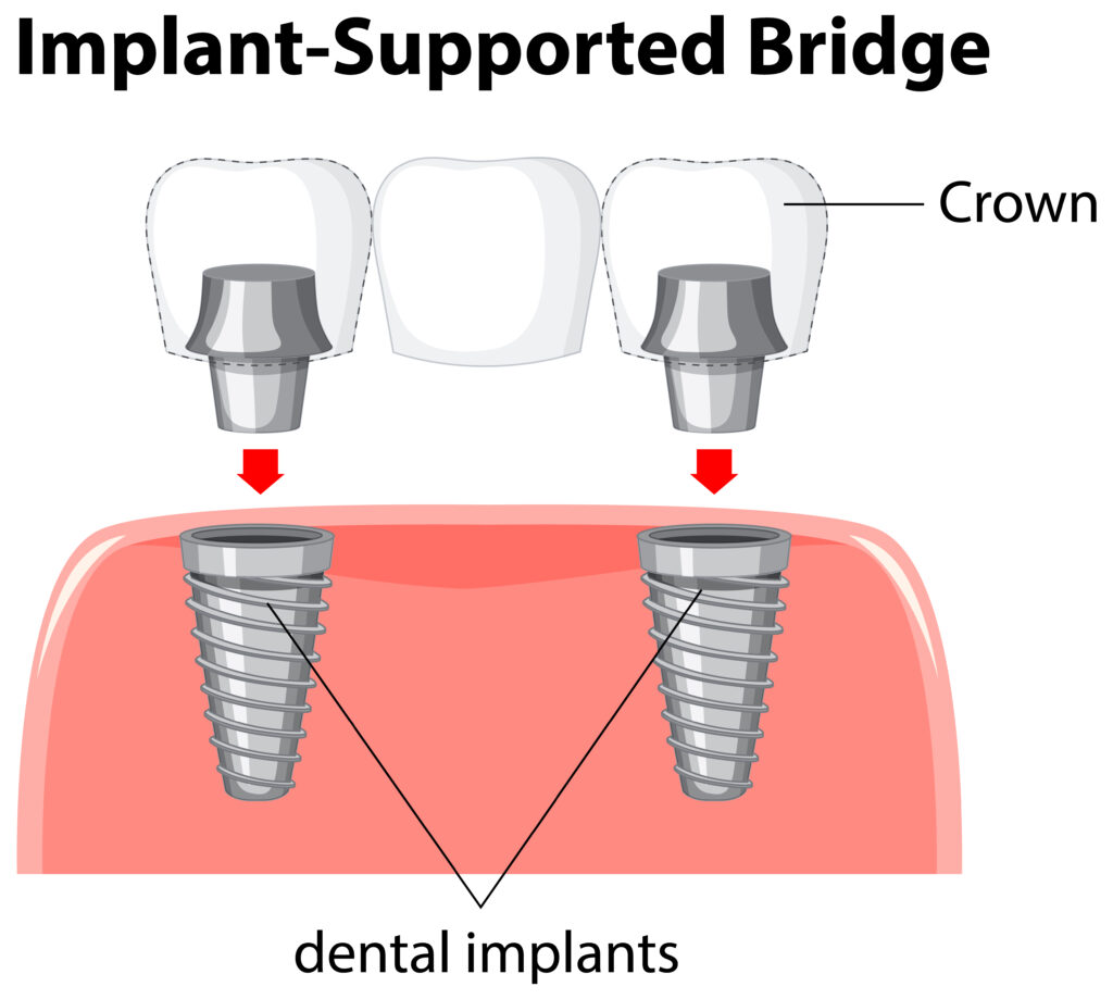Infografía puente dental