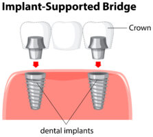 Infografía puente dental