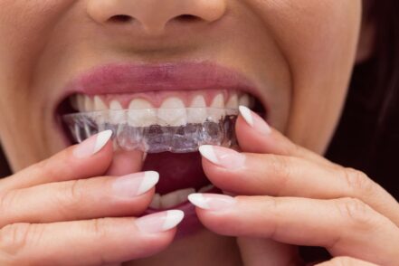 Una mujer se pone su Invisalign