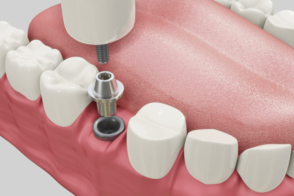 Implantes dentales