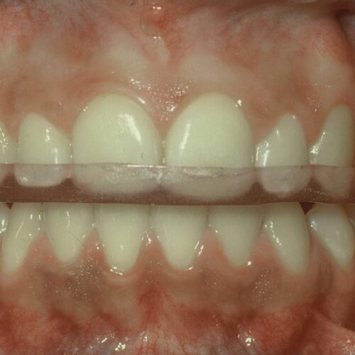 En la clinica, cuando es tratamiento de adultos, recomendamos terminar con un guarda oclusal rígido. Es mas duradero y mantiene los dientes en su posición.
