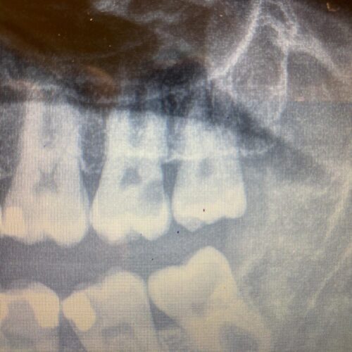 Caries en segundo molar