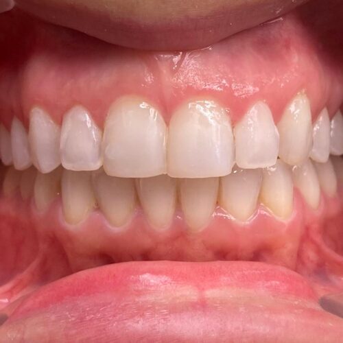 Caso inicial, ortodoncia y odontología estética