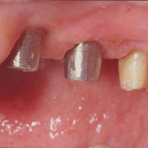 Implantes dentales 2