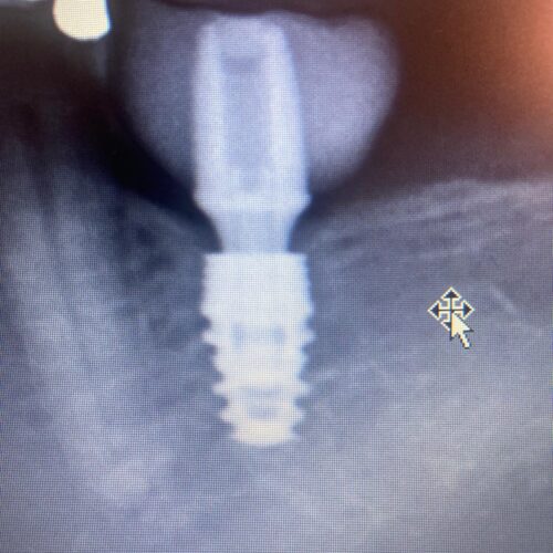 Implante corto. A veces necesario por la sección, por la anchura mandibular o por preservar.