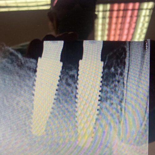 Implantes de buena longitud para molares