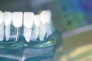 Los implantes dentales son preferiblemente para personas adultas
