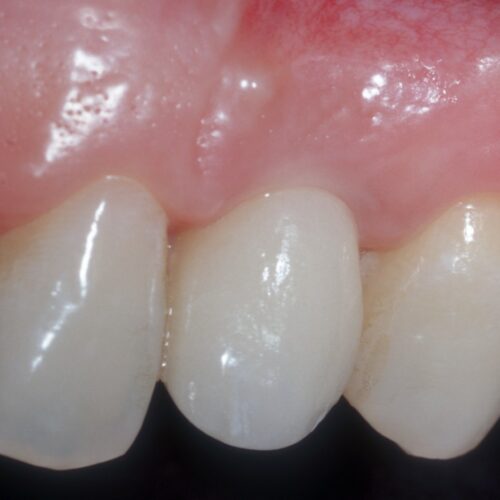 Implantes dentales 3