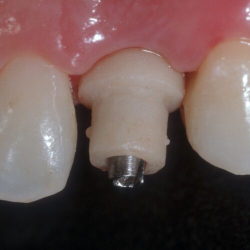 Implantes dentales