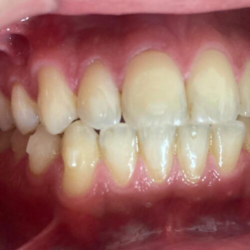 los alineadores necesitan que algunos dientes lleven topes